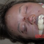 Brutally raped girl