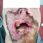 Burned face plastic surgery