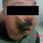 Burned face plastic surgery