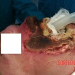 Burned face plastic surgery