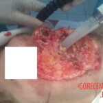 Burned face plastic surgery