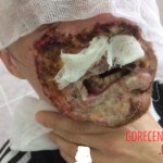 Burned face plastic surgery