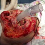 Burned face plastic surgery