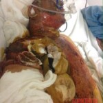 Burned man in hospital