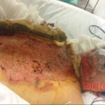Burned man in hospital