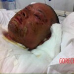 Burned man in hospital