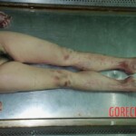 Female in morgue
