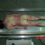 Female in morgue
