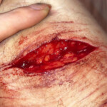 Cinnamonnoir self-harm