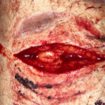 Cinnamonnoir self-harm