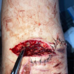 Cinnamonnoir self-harm