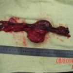 Autopsy of Chinese woman