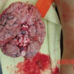 Autopsy of Chinese woman