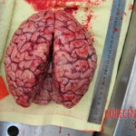 Autopsy of Chinese woman