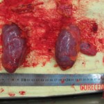 Autopsy of Chinese woman