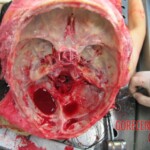 Autopsy of Chinese woman