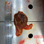 Autopsy of Chinese woman