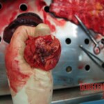 Autopsy of Chinese woman