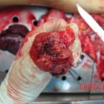 Autopsy of Chinese woman