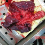 Autopsy of Chinese woman