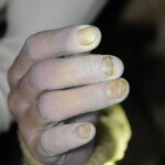 Drowned woman in morgue