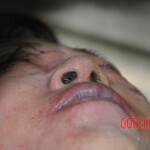 Drowned woman in morgue