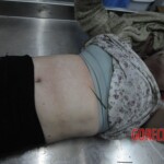 Drowned woman in morgue