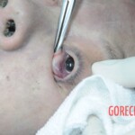 Drowned woman in morgue