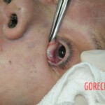 Drowned woman in morgue