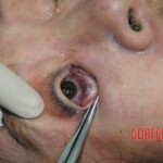 Drowned woman in morgue