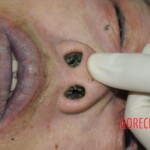 Drowned woman in morgue