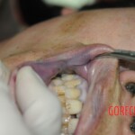 Drowned woman in morgue