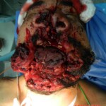 Blown off face surgery