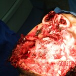 Blown off face surgery