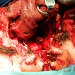 Blown off face surgery