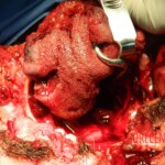 Blown off face surgery