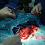 Blown off face surgery