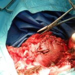 Blown off face surgery