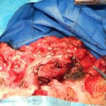 Blown off face surgery