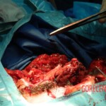 Blown off face surgery