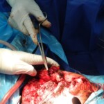 Blown off face surgery