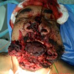 Blown off face surgery