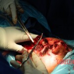 Blown off face surgery