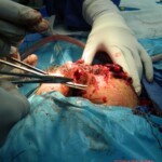 Blown off face surgery