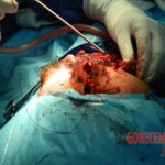 Blown off face surgery