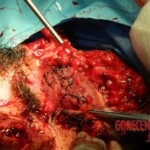 Blown off face surgery