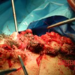 Blown off face surgery