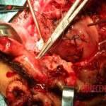 Blown off face surgery