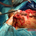 Blown off face surgery