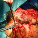 Blown off face surgery